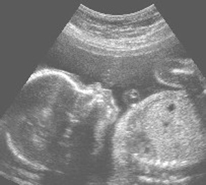 ultrasound obstetric nuchal dating scan