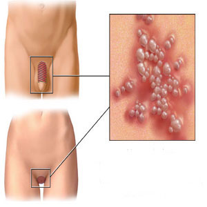 dating with hsv 1 oral